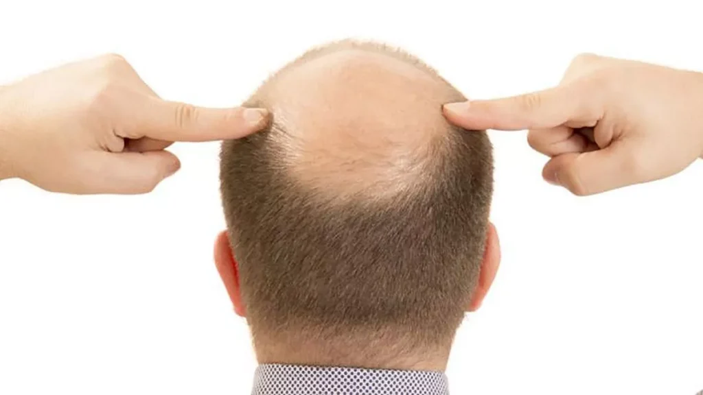 Foto de hombre con alopecia